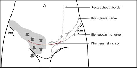 The Ilio Inguinal And Iliohypogastric Nerve Blocks With Local