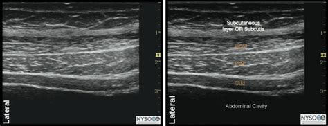 Ilioinguinal Nerve Block Procedure