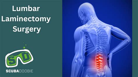 Lumbar Laminectomy Surgery And General Update Youtube