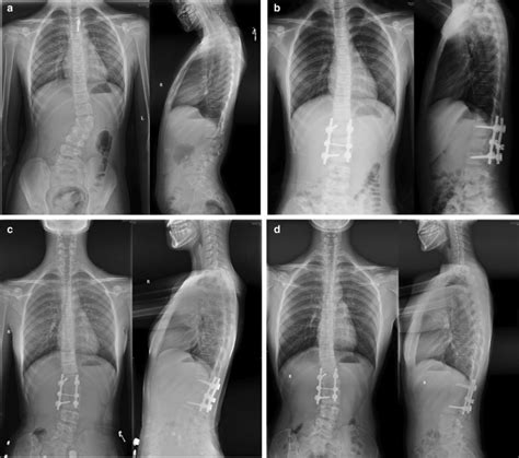 Radiograph Of A Patient With Congenital Scoliosis A Hemivertebra Is