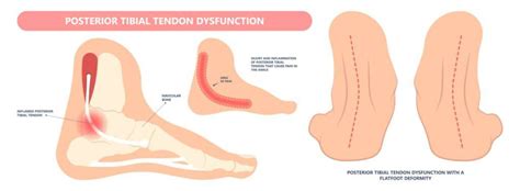 Posterior Tibial Tendonitis Brace