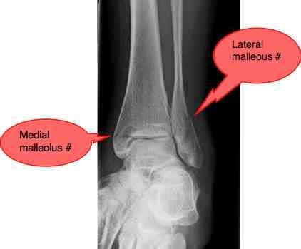 Posted 4 years ago, 8 users are following. Ankle fracture is in the first instance a job for a surgeon.