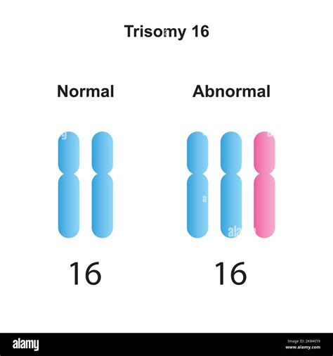 Scientific Designing Of Mosaic Trisomy 18 Karyotype Colorful Symbols