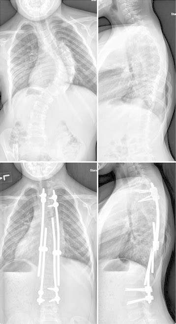 Radiographs Of A Patient With Early Onset Scoliosis Preoperative Top