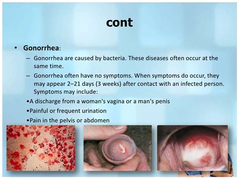 What are the symptoms of syphilis? Different between syphilis & gonorrhea