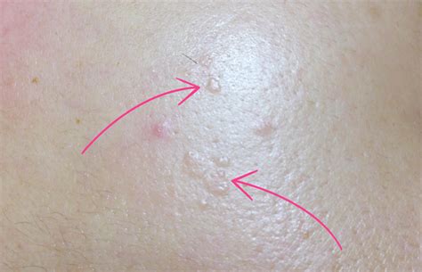 Different Types Of Bumps On Skin