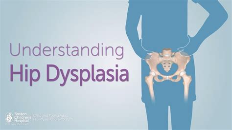 Understanding Hip Dysplasia Boston Childrens Hospital Youtube