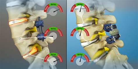 Spinal Stenosis Treatment Tops™ System By Premia Spine