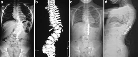 A 7 Years 4 Months Girl With Congenital Scoliosis Radiographs And