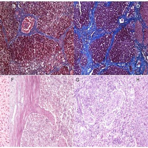 Fibrose Histologia