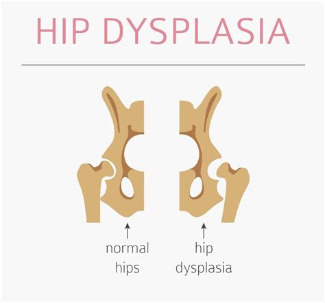 10 Frequently Asked Questions About Hip Dysplasia Facty Health