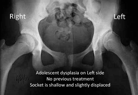 Acetabular Dysplasia