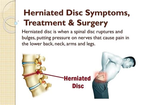 PPT Herniated Disc Symptoms Treatment Surgery PowerPoint