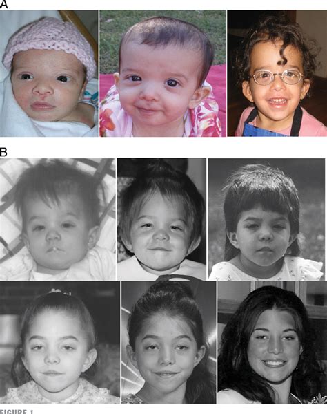 Noonan Syndrome Neonate