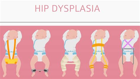 Hip Dysplasia Infants Image1 Babies Carrier