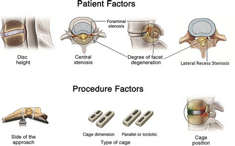 Indirect Decompression Failure After Lateral Lumbar Interbody Fusion