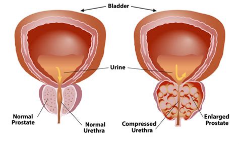 Benign Prostatic Hyperplasia BPH Signs And Symptoms