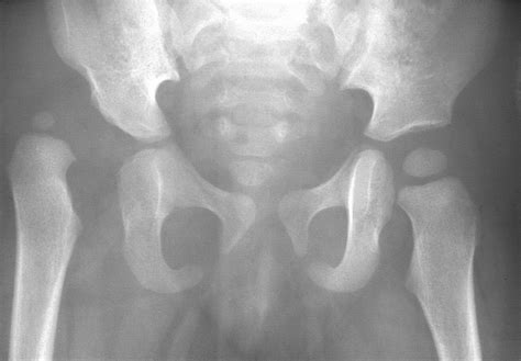 Diagnosis And Management Of Developmental Hip Dysplasia Paediatrics