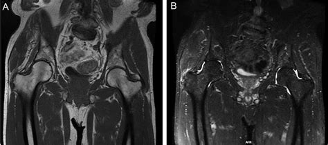 T1 A And T2 B Coronal Magnetic Resonance Images Show High Grade