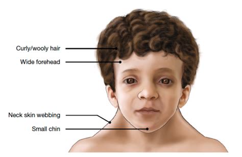 Faqs Noonan Syndrome Association