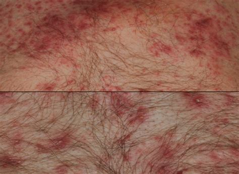 Red Spots On Chest Causes At Cory Whitehead Blog