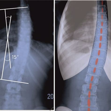 Medium Rotated Scoliosis Ati And The Cobb Angle Correlate With Each