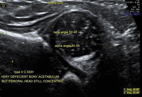 Developmental Dysplasia Of Hip Ddh Looking Through A Transducer