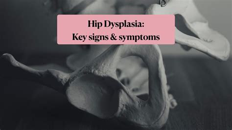 Hip Dysplasia Key Signs And Symptoms Youtube