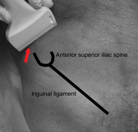 Ilioinguinal And Iliohypogastric Nerve Blocks Anesthesia Key