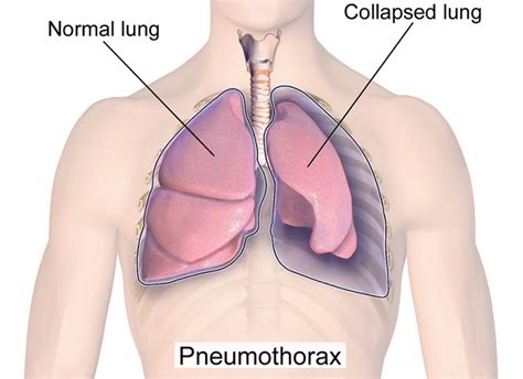 Penatalaksanaan Pneumothorax Alomedika