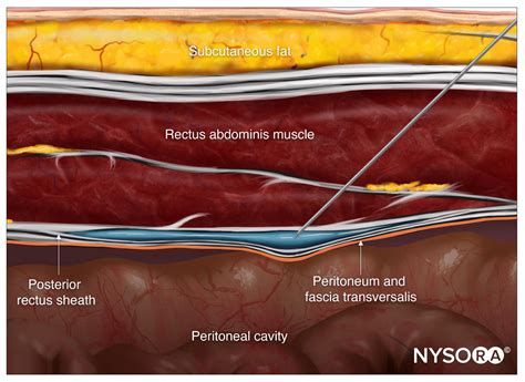 Ilioinguinal Nerve Block Nysora Images And Photos Finder