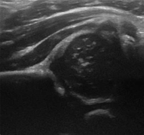 Hip Dysplasia Ultrasound Introduced At Columbiadoctors Tarrytown