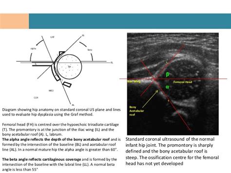 Anatomy Hip Joint Congenital Hip Dislocation Ultrasound Angles