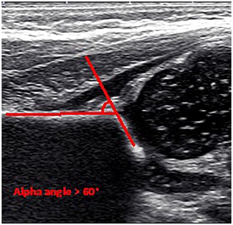 Normal Acetabular Angle On A Hip Ultrasound Within 3 Months Of Birth