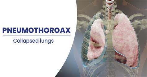 Pneumothorax Types Symptoms And More