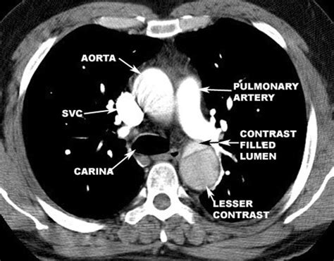 Dissecting Aorta