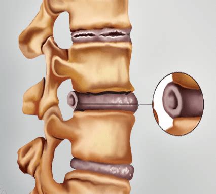 What Is A Bulging Disc Spine Orthopedic Center