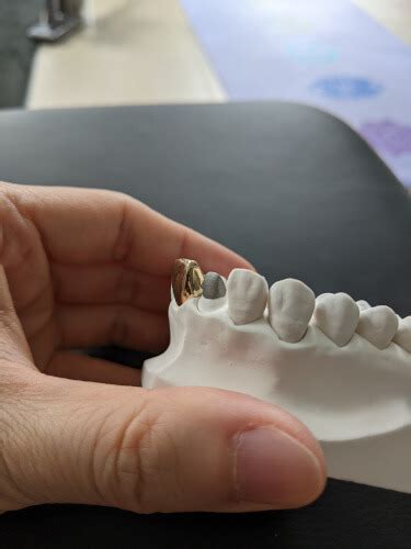 What Does A Crown Look Like On A Tooth Images And Videos Afterva