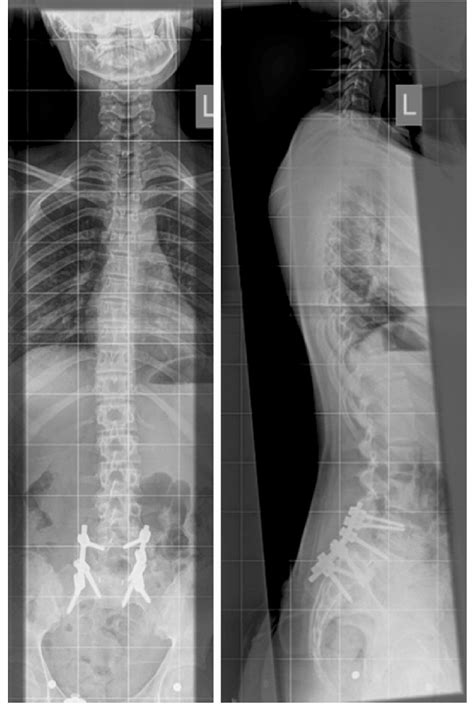 Correlation Between Shunt Series And Scoliosis Radiographs In Children