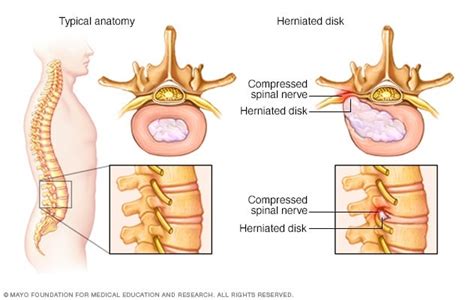 Herniated Disk Symptoms And Causes Mayo Clinic