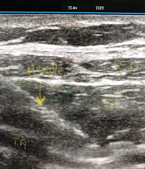 Picture Of Ultrasound Guided Ilioinguinal Iliohypogastric Nerve Block