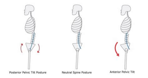 The Ultimate Guide To Posture Correction Spine And Posture Care Sydney