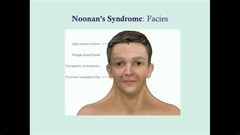 Noonan S Syndrome CRASH Medical Review Series YouTube