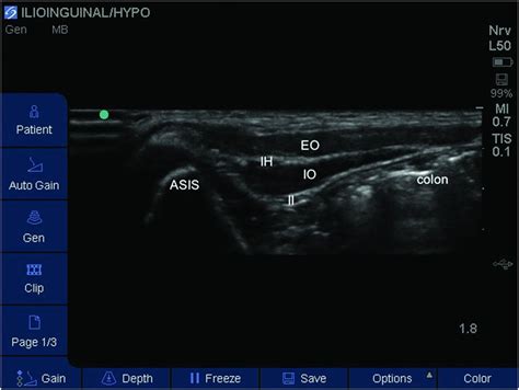 Ultrasound Guided Ilioinguinal Iliohypogastric Block Anesthesia Key