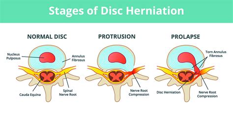 Frequently Asked Questions On Spine Surgery For Disc Herniation Spine