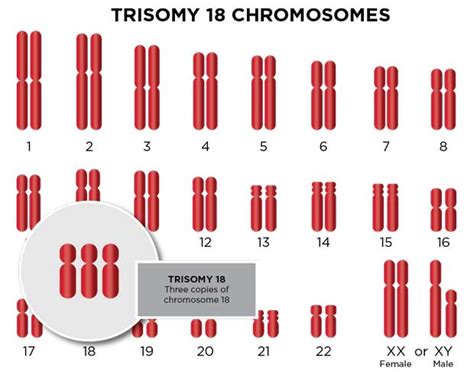 Trisomy 18 Edwards Syndrome Types And Diagnosis