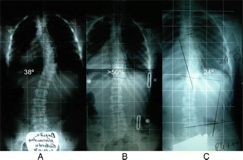 1a B C Series Of Radiographs Of A Patient With Progressive