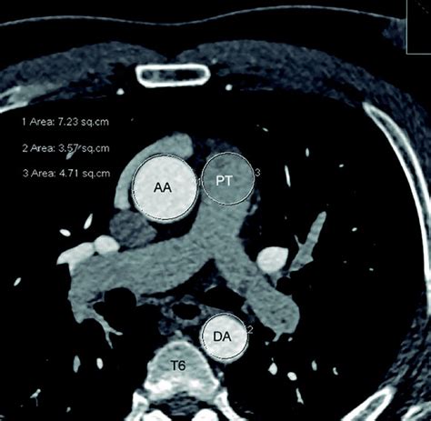 Sex Specific Parameters Of Ascending Aorta Descending Aorta And