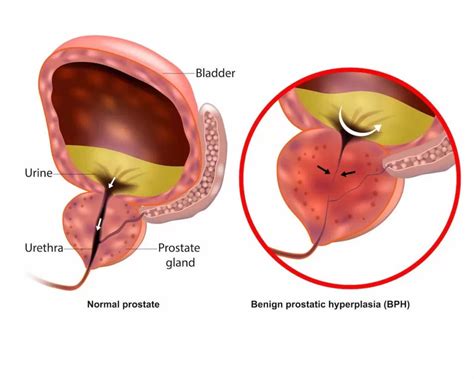 Understanding And Managing Benign Prostatic Hyperplasia