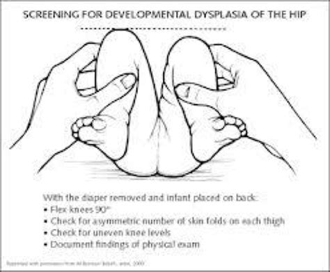 Buy Signs Of Hip Dysplasia In Toddler